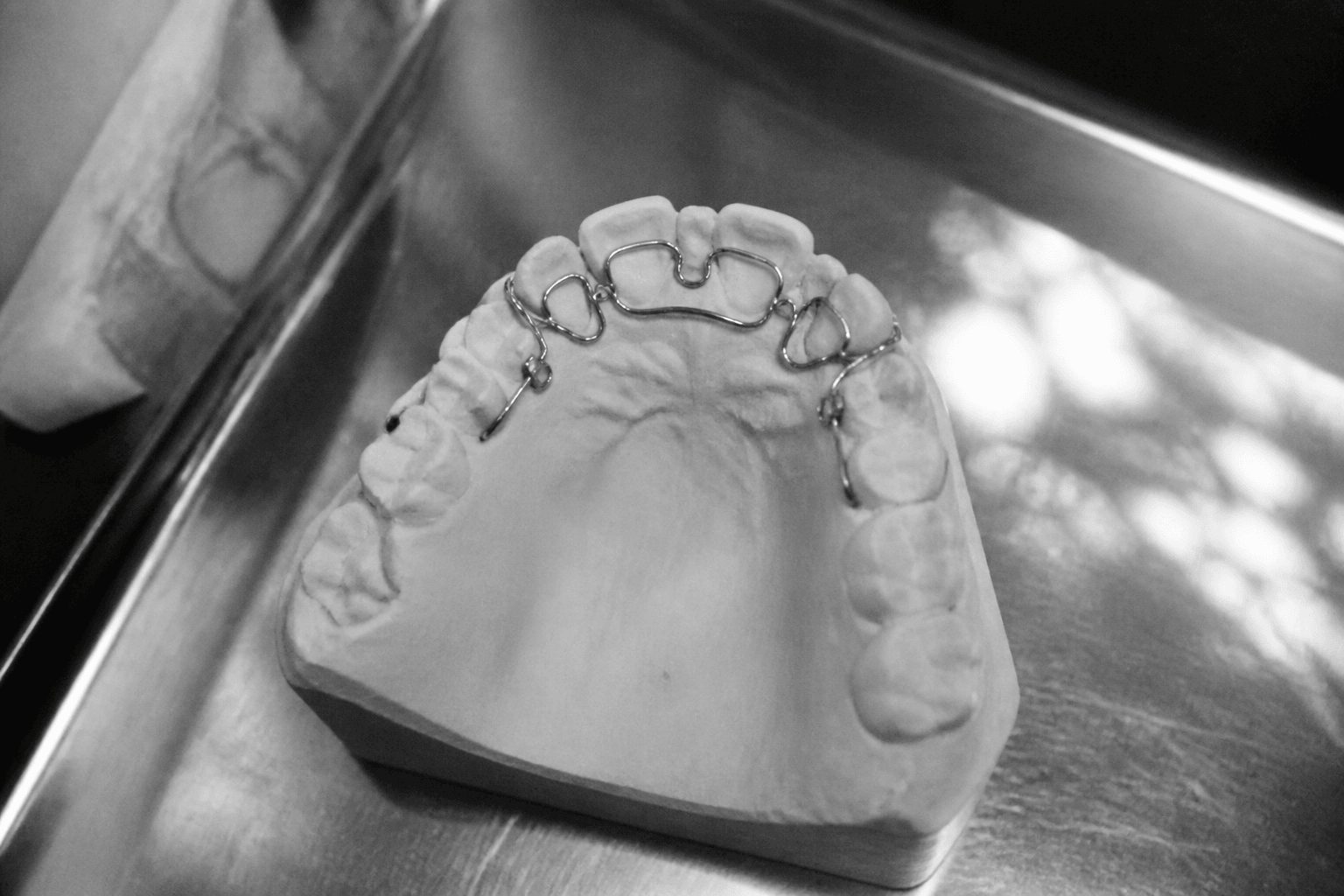 Why Do Front Teeth Flare After Braces? What to Check