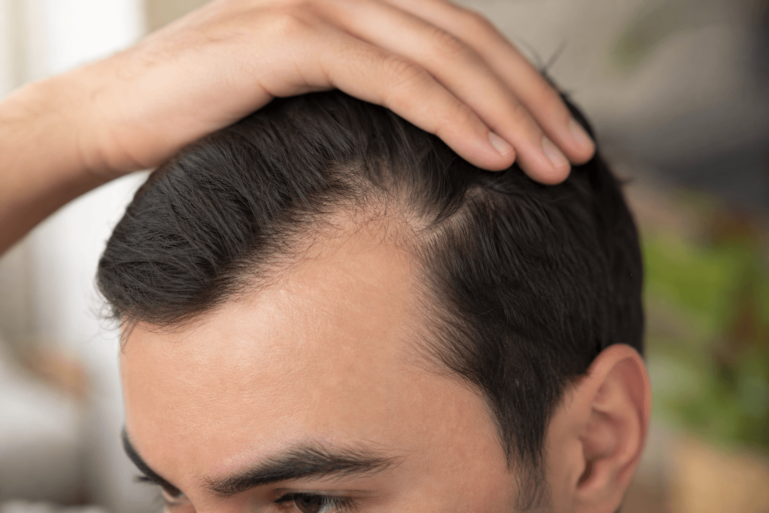 Does Minoxidil Work for a Receding Hairline? The Evidence
