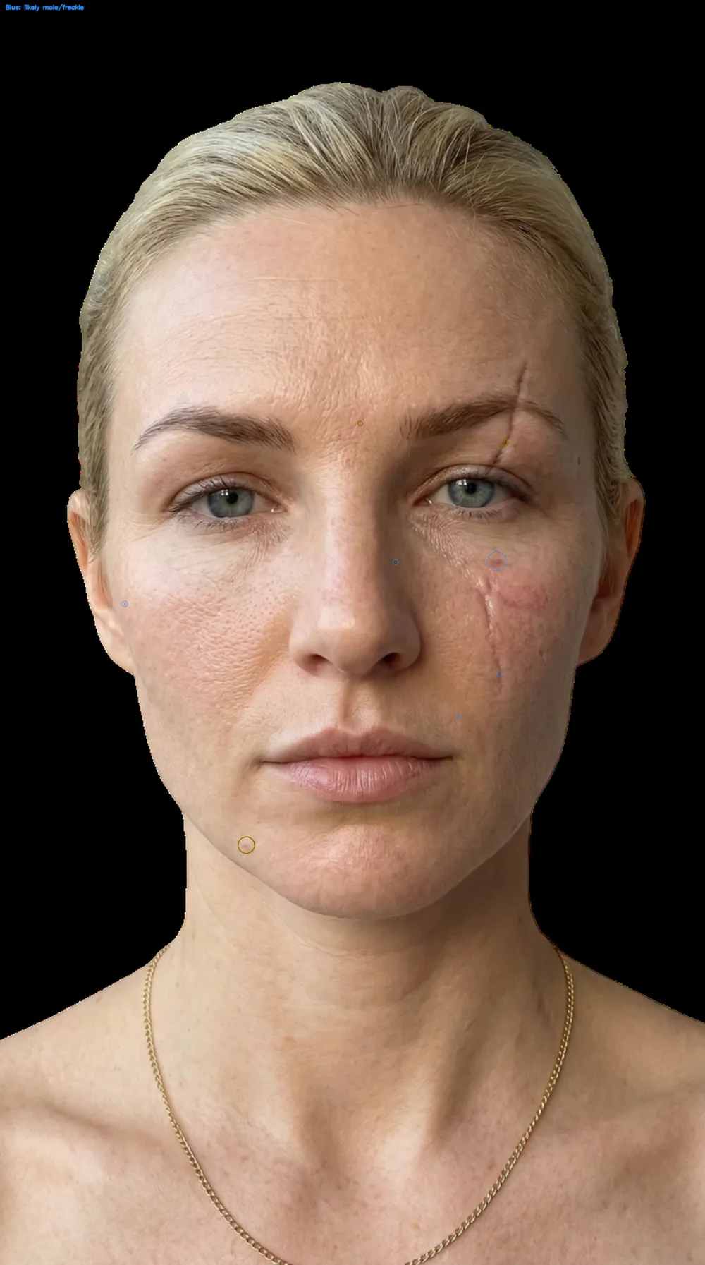 Acne detection overlay