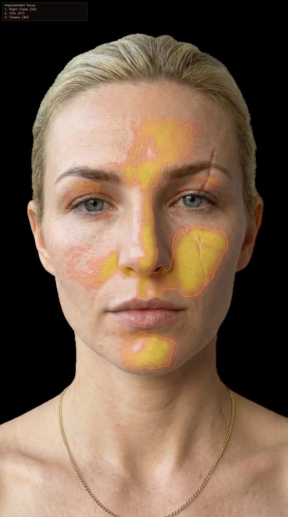 Redness hotspot zones outlined on the face